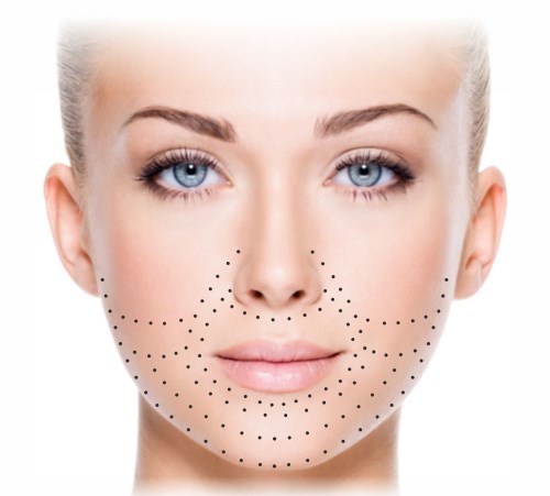 Biorevitalisasi untuk wajah. Teknik, peringkat kursus, ciri prosedur