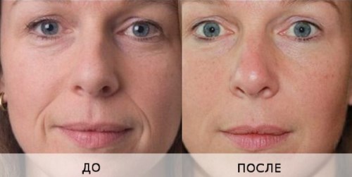 Biorevitalisatie voor het gezicht. Technieken, fasen van de cursus, kenmerken van de procedure