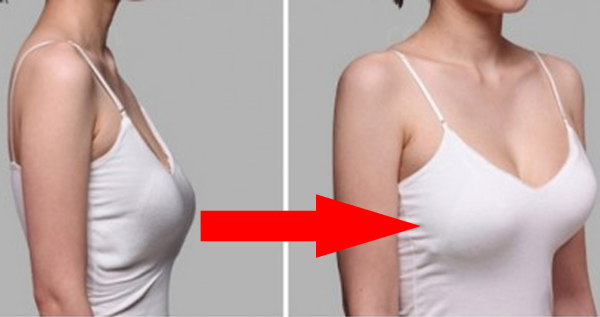 Pembesaran payudara dengan implan berbentuk air mata pada mamoplasti. Foto sebelum dan selepas