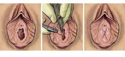 Hymenoplasty - apakah itu, sebelum dan selepas gambar, peringkat operasi, hasil, pemulihan dan kemungkinan komplikasi