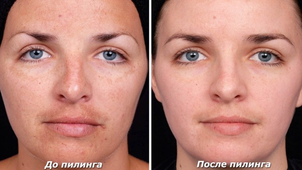 Chemische peeling van het gezicht - wat is het, hoe wordt het thuis gedaan, soorten en kenmerken