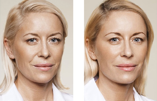 Biorevitalisatie van het gezicht, lippen, handen, nek, rond de ogen. Effect na de procedure. Prijs. Foto's voor en na. Beoordelingen