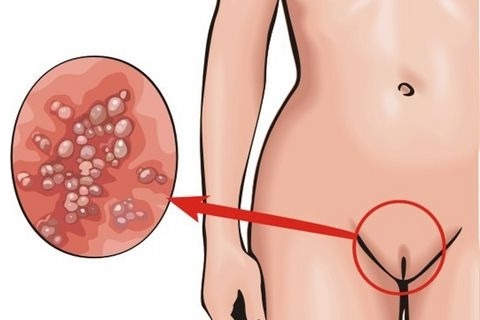 HPV bei Frauen - was ist es, Symptome, Typen, wie wird es übertragen, Behandlung des humanen Papillomavirus in der Gynäkologie
