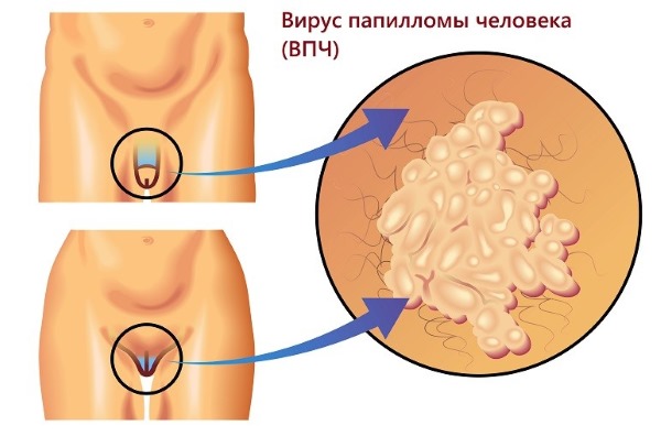HPV στις γυναίκες - τι είναι, συμπτώματα, τύποι, πώς μεταδίδεται, θεραπεία του ιού του ανθρώπινου θηλώματος στη γυναικολογία