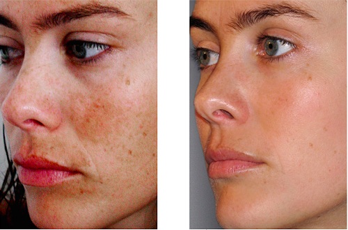 Chemische peeling voor het gezicht in de salon en thuis. Recensies, voor en na foto's, voor- en nadelen