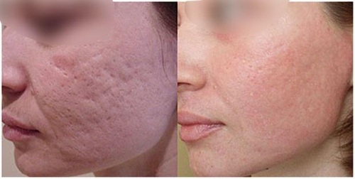 Chemische peeling voor het gezicht in de salon en thuis. Recensies, voor en na foto's, voor- en nadelen