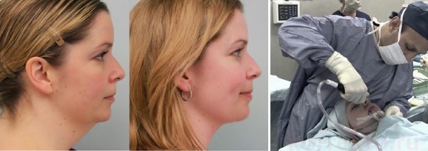 Liposuction dagu dengan laser. Foto, bagaimana prosedur dijalankan, tempoh pemulihan, akibatnya, ulasan