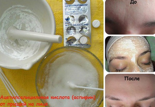 Acetylsalicylzuur voor de gezichtshuid. Recepten voor maskers, peeling voor acne, rimpels. Resultaten en foto's