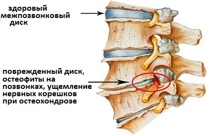 Otot belakang: senaman untuk menguatkan di rumah, di gim, dengan osteochondrosis, scoliosis