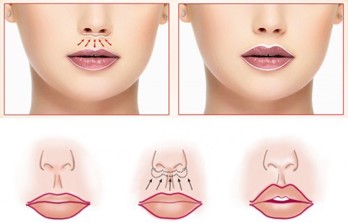 Πώς να μεγεθύνετε τα χείλη με υαλουρονικό οξύ, botox, σιλικόνη, λιποπλήρωση, χηλοπλαστική. Φωτογραφίες, τιμές, κριτικές