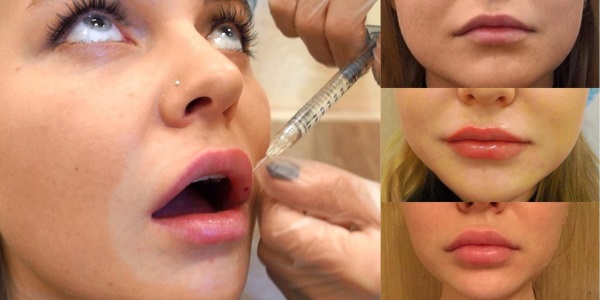 Πώς να μεγεθύνετε τα χείλη με υαλουρονικό οξύ, botox, σιλικόνη, λιποπλήρωση, χηλοπλαστική. Φωτογραφίες, τιμές, κριτικές