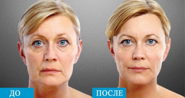 Lipolitik Dermahil dalam mesoterapi untuk wajah. Sebelum dan selepas gambar, harga, ulasan
