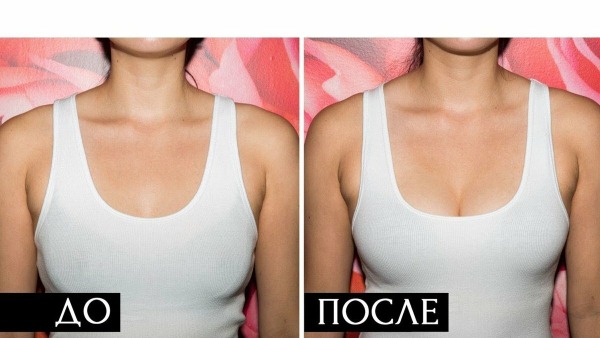 Pengangkatan payudara dengan dan tanpa implan. Sebelum dan selepas gambar, bagaimana caranya, harga