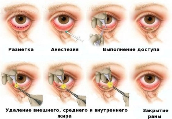 Pag-opera at di-kirurhiko pag-angat ng eyelid. Circular blepharoplasty, mesothreads, laser, botox. Mga larawan, presyo
