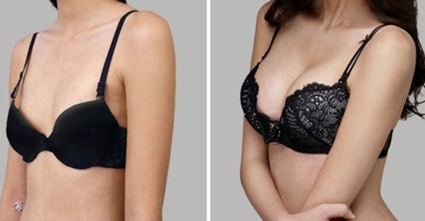Cirugía de aumento de senos. Fotos de chicas con pechos grandes, resultados, posibles complicaciones.
