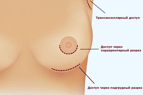 Pembedahan pembesaran payudara. Foto kanak-kanak perempuan dengan payudara besar, hasil, kemungkinan komplikasi