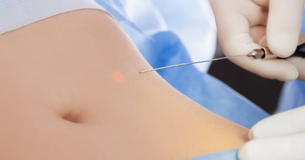 Liposuction laser pada perut. Foto, pemulihan, akibat, harga, ulasan