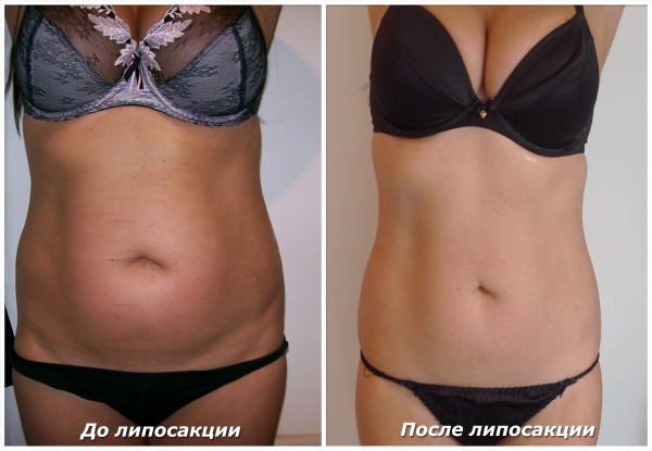 Liposucción láser de abdomen. Foto, rehabilitación, consecuencias, precio, críticas.