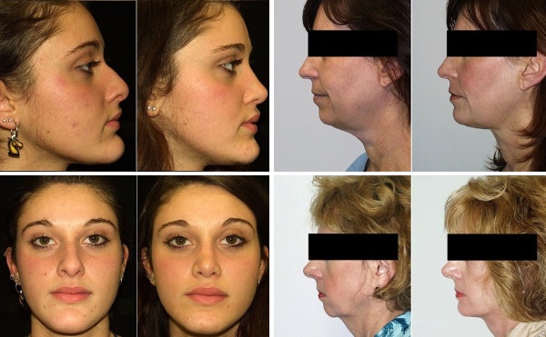 Gesichtskontur vom Doppelkinn. Fotos vor und nach der Operation, Preis, Bewertungen