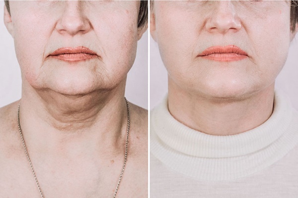 Contorno facial desde la papada. Fotos antes y después de la cirugía, precio, reseñas.