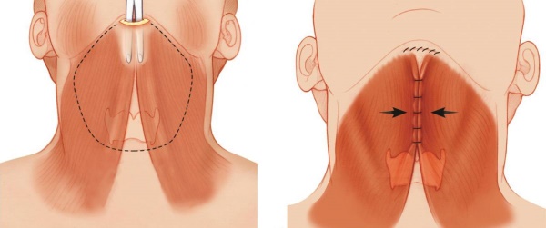 Gesichtskontur vom Doppelkinn. Fotos vor und nach der Operation, Preis, Bewertungen