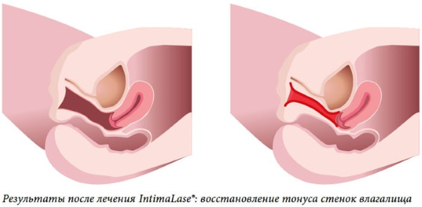 Laser meremajakan vagina (vaginoplasty selepas melahirkan). Ulasan, harga