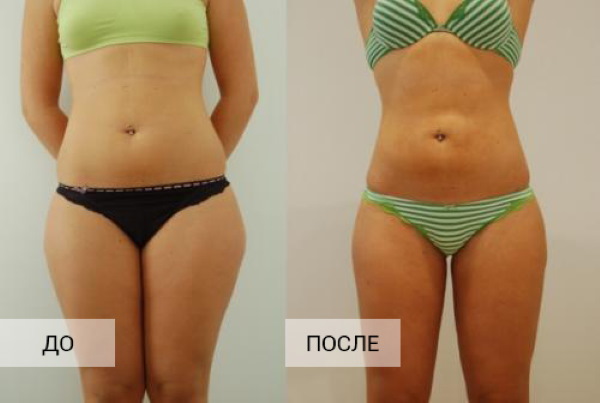Liposuction paha, kaki tebal pada wanita. Sebelum dan selepas gambar, harga, ulasan