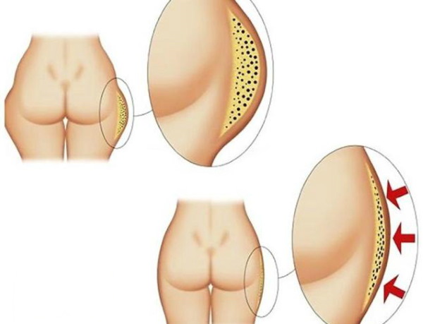 Liposuctie van dijen, dikke benen bij vrouwen. Voor en na foto's, prijs, recensies