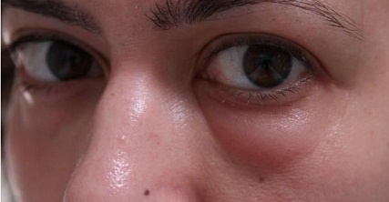 Botox di bawah mata. Sebelum dan selepas foto, kesan, ulasan, akibat