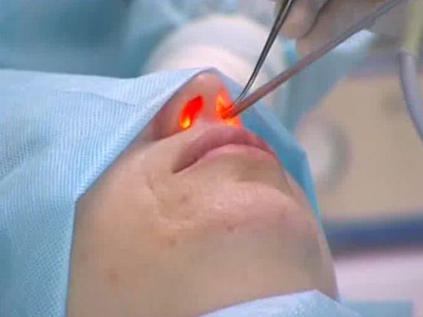 Ein Buckel auf der Nase des Mädchens. Schön oder nicht, wie man ohne Operation entfernt, Nasenkorrektur
