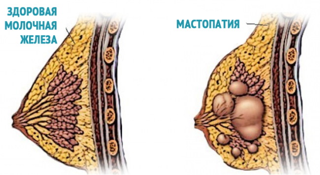 Σωληνοειδής μορφή μαστικών αδένων, μαστών. Φωτογραφία, διόρθωση χωρίς χειρουργική επέμβαση για γυναίκες, άνδρες