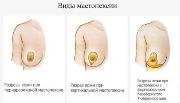 Röhrenförmige Form der Brustdrüsen, Brüste. Foto, Korrektur ohne Operation für Frauen, Männer