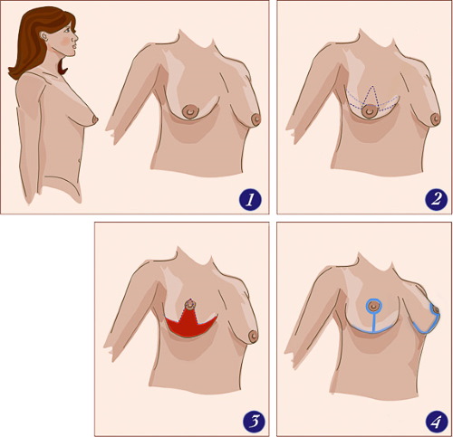 شكل أنبوبي من الغدد الثديية والثدي. تصوير ، تصحيح بدون جراحة للنساء والرجال