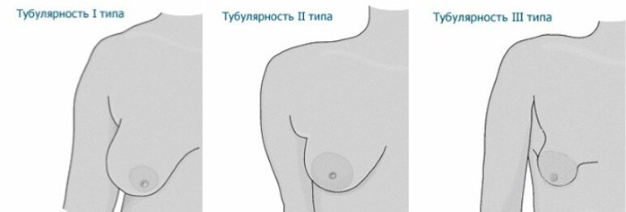 شكل أنبوبي من الغدد الثديية والثدي. تصوير ، تصحيح بدون جراحة للنساء والرجال