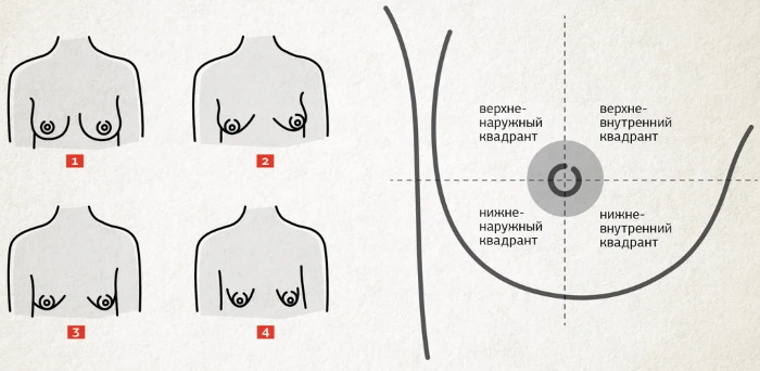 Röhrenförmige Form der Brustdrüsen, Brüste. Foto, Korrektur ohne Operation für Frauen, Männer