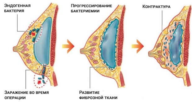 Σωληνοειδής μορφή μαστικών αδένων, μαστών. Φωτογραφία, διόρθωση χωρίς χειρουργική επέμβαση για γυναίκες, άνδρες