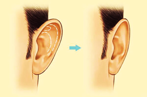 جراحة الأذن لعلاج ترهل الأذن. ماهو السعر