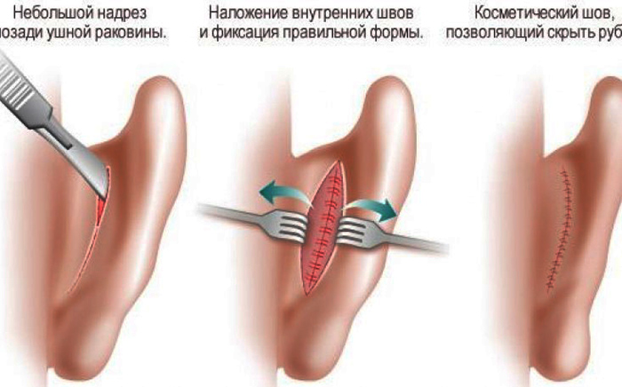 جراحة الأذن لعلاج ترهل الأذن. ماهو السعر