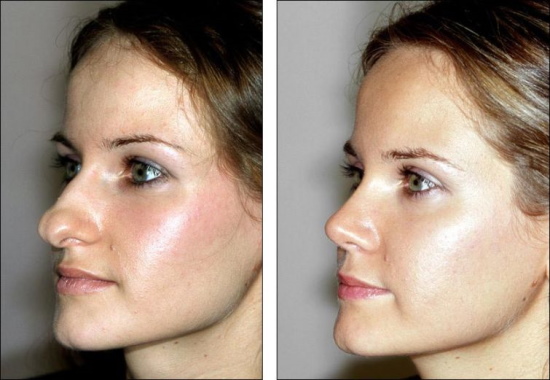 Gadis itu mempunyai hidung yang panjang. Gambar sebelum dan selepas rhinoplasty