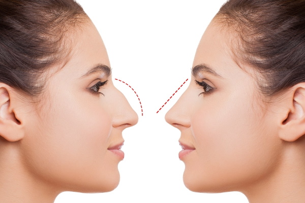 Gadis itu mempunyai hidung sumbing. Cara membetulkan sebelum dan selepas gambar rhinoplasty
