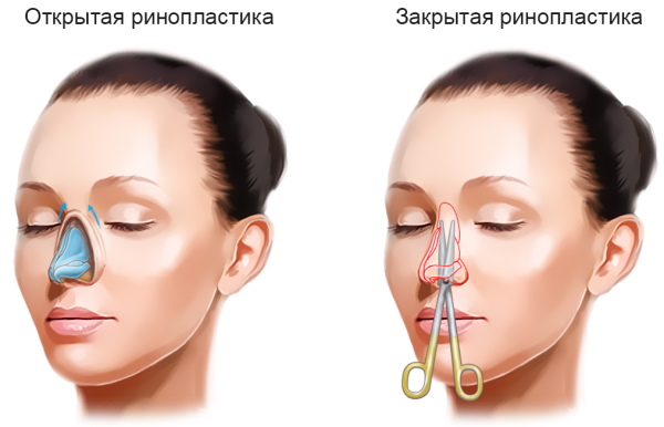 Το κορίτσι έχει μύτη. Πώς να διορθώσετε πριν και μετά τις φωτογραφίες της ρινοπλαστικής