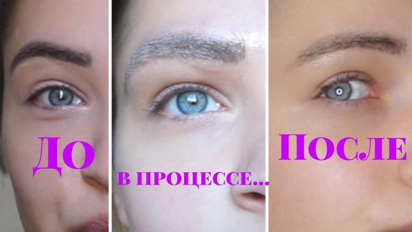 Laserverwijdering van permanente make-up (tatoeage) van wenkbrauwen, lippen, oogleden