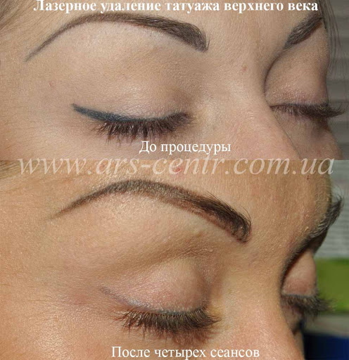 Laserverwijdering van permanente make-up (tatoeage) van wenkbrauwen, lippen, oogleden