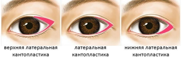 Mädchen haben kleine Augen. Wie man den Preis für plastische Chirurgie erhöht