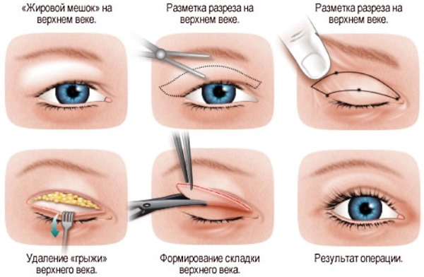 Πλαστική χειρουργική στα βλέφαρα. Πριν και μετά τις φωτογραφίες, την τιμή, τις κριτικές