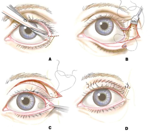 Πλαστική χειρουργική στα βλέφαρα. Πριν και μετά τις φωτογραφίες, την τιμή, τις κριτικές