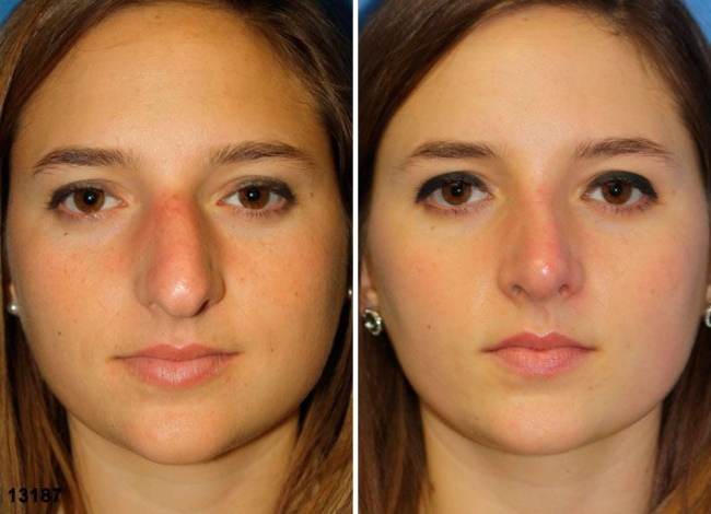 Gadis itu mempunyai hidung besar. Gambar sebelum dan selepas rhinoplasty