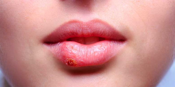 Gadis mempunyai bibir nipis. Cara meningkatkan dengan asid hyaluronik, pengisi, botox